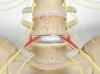 Artificial Disc Replacement (in the Lumbar Spine)