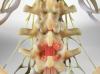 Laminotomy (of the Lumbar Spine)