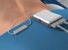 Spinal Cord Stimulator Implant (Trial Procedure)