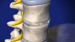 Anterior Lumbar Interbody Fusion 