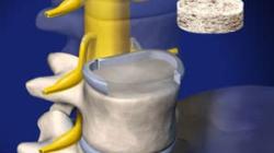 ALIF: Anterior Lumbar Interbody Fusion 