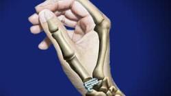 Basal Joint Surgery