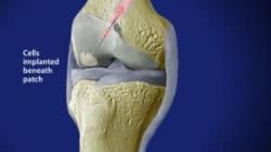 Cartilage Repair