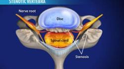 Laminectomy (Cervical)