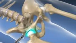 Hip Joint Injection
