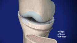 High Tibial Osteotomy