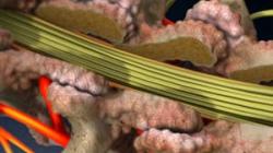 Laminectomy
