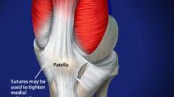 Lateral Release and Medial Imbrication