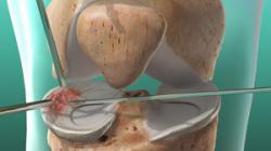 Meniscus Repair