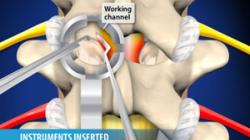 Minimally-Invasive Lumbar Microdecompression