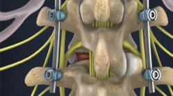 Minimally-Invasive TLIF