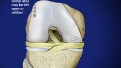 OATS Cartilage Repair Surgery