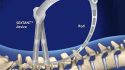 Lumbar Pedicle Screw Fixation