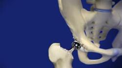 Revision Hip Surgery