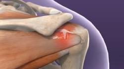 Rotator Cuff Injuries