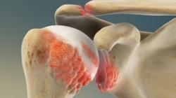 Osteoarthritis of the Shoulder