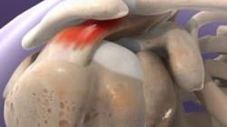 Subacromial Decompression