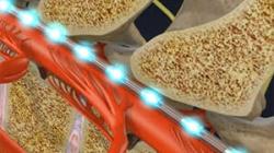 Spinal Cord Stimulator Implant