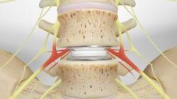 Artificial Disc Replacement (in the Lumbar Spine)