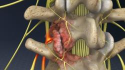 Foraminotomy (Lumbar Spine)