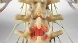 Laminotomy (of the Lumbar Spine)