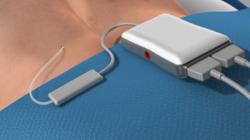 Spinal Cord Stimulator Implant (Trial Procedure)