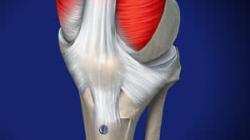 Tibial Tubercle Osteotomy
