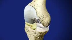 Uni Knee Resurfacing